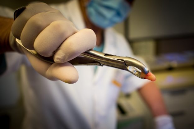 clipping a tooth